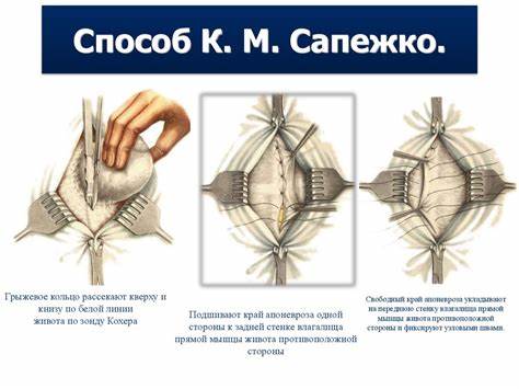 Диета для грыжи диафрагмы Пупочная Грыжа Реабилитация После Операции — Buy-artox.ru Пупочная Грыжа Реабилитация После Операции — Buy-artox.ru Диета для грыжи диафрагмы