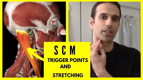 Dizziness Headaches And Neck Pain From Scm Trigger Points Youtube