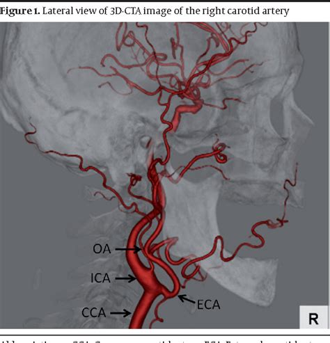 Occipital Artery Branches
