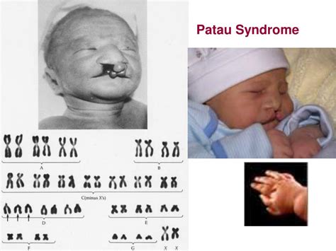 Ppt Chromosome Abnormalities Powerpoint Presentation Free Download