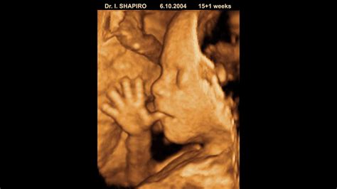 Usai refers to these detailed 3d and 4d ultrasounds as 'emotional ultrasounds,' as it grants the wish of parents who want to see their baby in the womb, though he makes sure to note. 3D fetal ultrasound - amazing things fetuses do in the ...