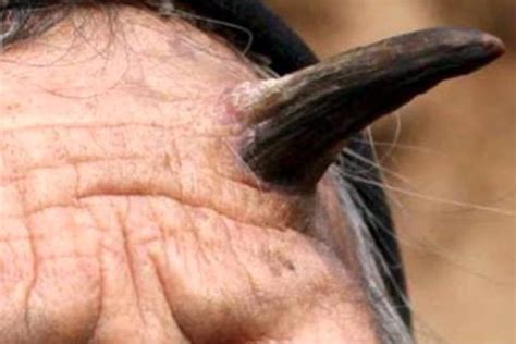Cutaneous Horn — The Skin Growth That Turns Humans Into Unicorns