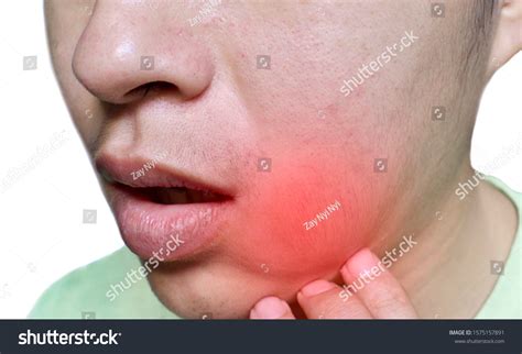 Painful Cheek Swelling Dental Abscess Lower Foto Stok 1575157891