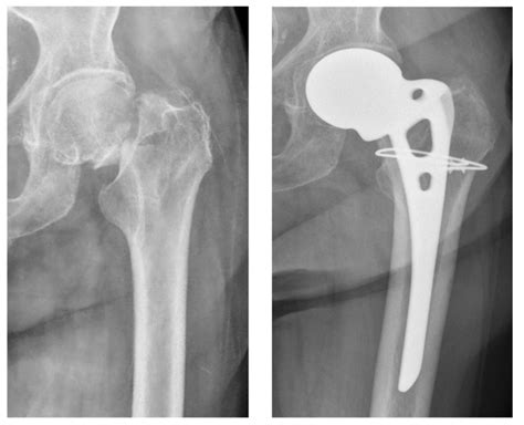 Intraoperative Periprosthetic Femoral Fracture Managed With Cerclage