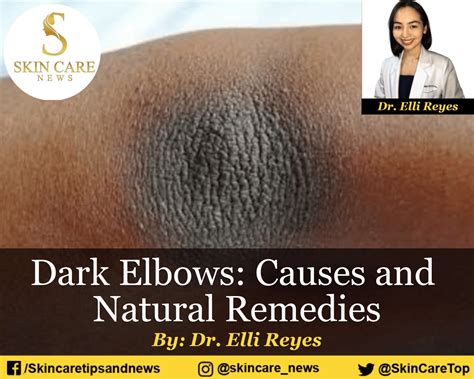 Dark Elbows Causes And Natural Remedies Skin Care Top News