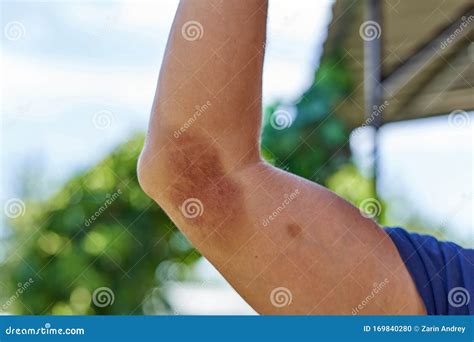 The Fragment Of The Hand With The Big Bruise Stock Photo Image Of