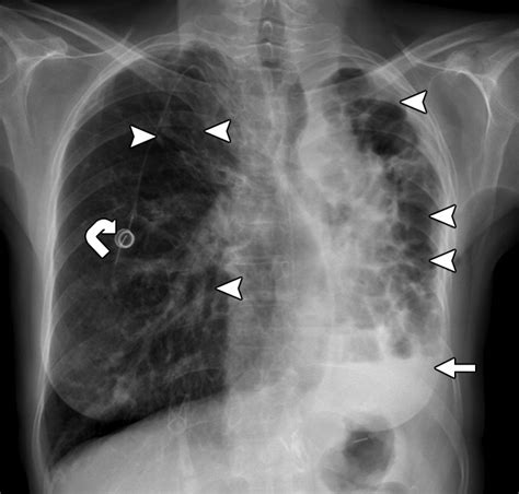 Imaging Of Cystic Fibrosis And Pediatric Bronchiectasis Ajr