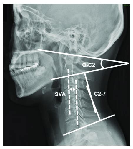 Measurement Of Cervical Sagittal Alignment On Radiographs Sva C2 7