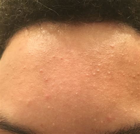 Have Had These Forehead Bumps For Around 10 Months How Do I Get Rid Of