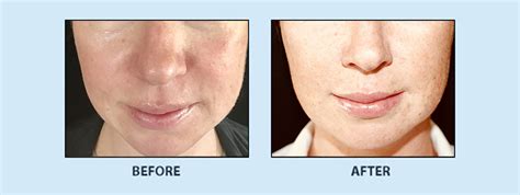 Permalip Before And After Dr Burt Greenberg Plastic Surgeon Located