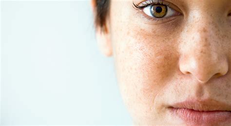 What Causes Brown Facial Spots And Other Important