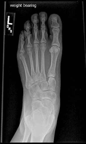 What Is A Nondisplaced Fracture Fracture Treatment