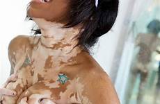 vitiligo shesfreaky