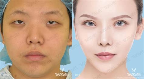 Le Wave Patient Transformation Story Wave Plastic Surgery