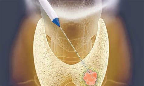 Thyroid Radiofrequency Ablation Saint Johns Cancer Institute