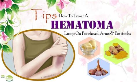 Abdominal Hematoma Treatment