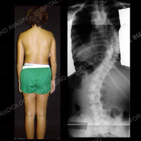 Scoliosis In Adults What To Know About Symptoms And Treatment