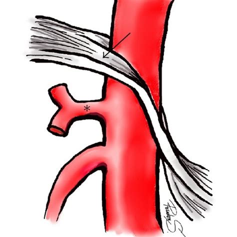 Celiac Angiography Of Mals A Shows Severe Stenosis Arrow With