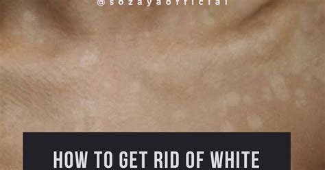 How To Get Rid Of White Spots On Body Sozaya