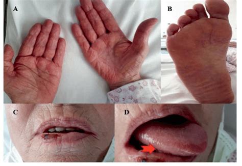 A B Palmar And Plantar Rash C D Lower Lip And Right Lateral Tongue