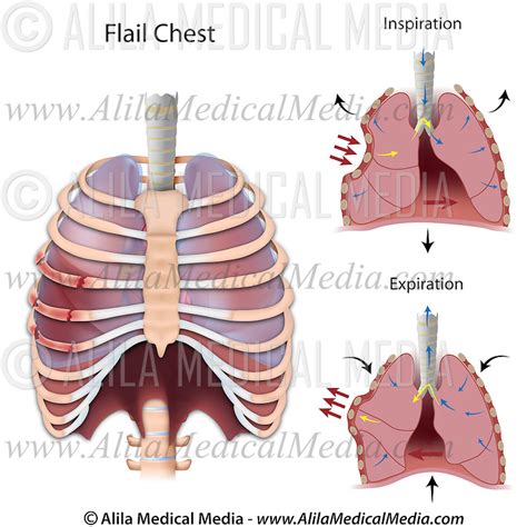 Flail Chest Alila Medical Images