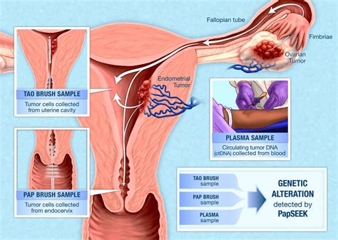 Results from a study of a blood test that can detect more than 50 types of cancer suggest that it is accurate enough to be used as a screening tool among people at higher risk of the disease, including those who are not symptomatic. PapSEEK Test for Endometrial and Ovarian Cancer - National ...