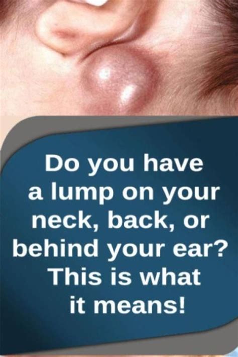 Vital Pieces Of Lumps On Neck Lump Behind Ear Skin Bumps Neck