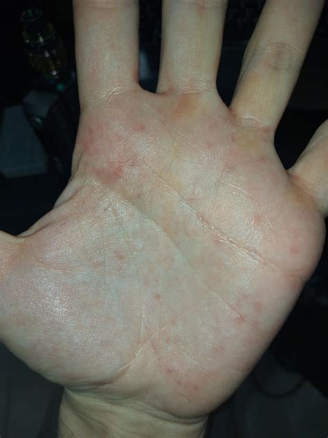 Anyone Know What These Red Spots Are They Only Ever Pop Up On My Palms