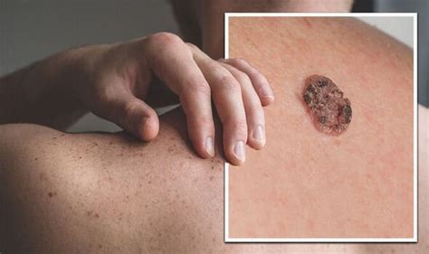 Skin Cancer Symptoms What Does Skin Cancer Look Like 10 Signs To Get