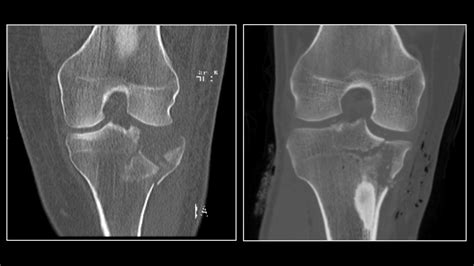 Ultra Low Dose Ct Scans Successfully Detect Fractures