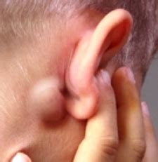 Lymph Node Behind The Ear Photo