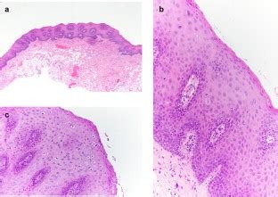 Hpv Related Papillary Lesions Of The Oral Mucosa A Review Springerlink
