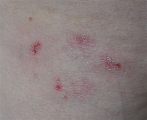 Inner Thigh Herpes Rash On Thigh The Gallery For Herpes Inner