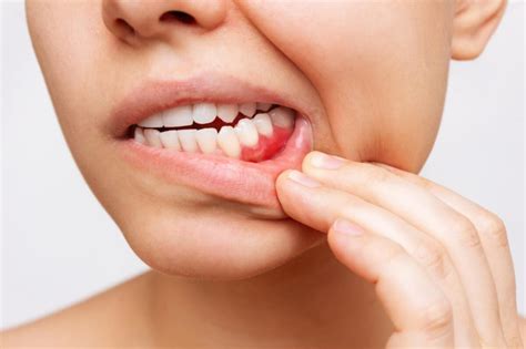 Understanding Gingivitis Causes Symptoms And Treatment Options Marketfair Dental Care