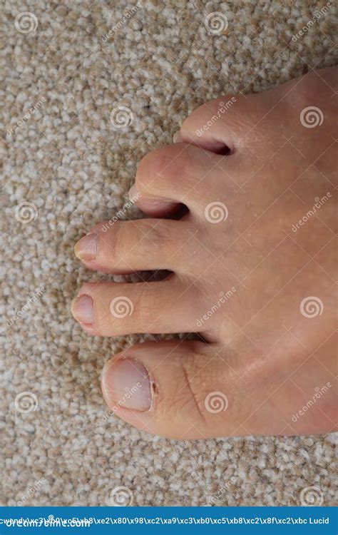 Sore Skin On Feet Dry Dehydrated Feet Of A Lady Five Toes With Clean