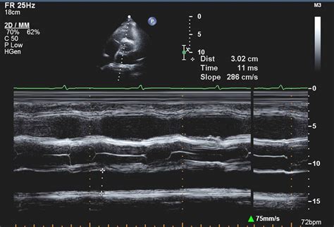 M Mode Echo Principles And Classic Findings Wikidoc