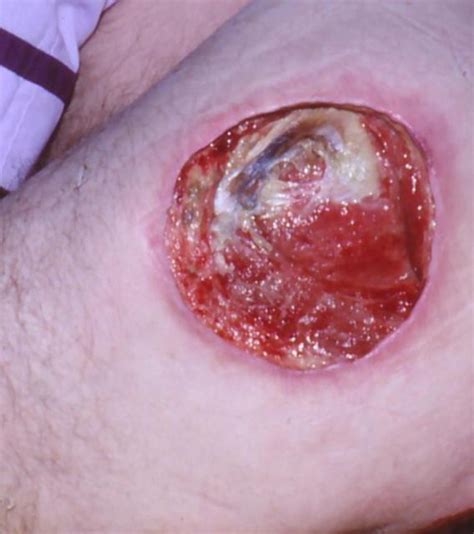 Decubitus Ulcer Chronic Ulcer Of Skin Pressure Ulcer Bedsore