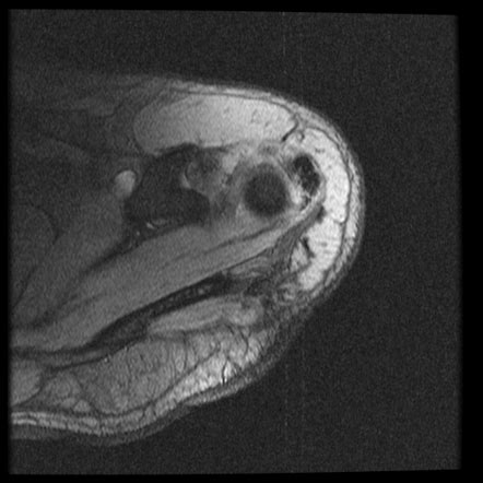 Calcific Tendinitis Of Supraspinatus Tendon Radiology Case