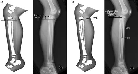 A Anterior Tilt Angle Of The Tibia Was Measured On A Lateral Radiograph