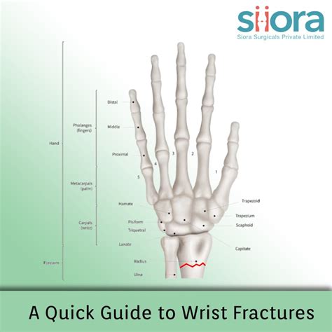 A Quick Guide To Wrist Fractures