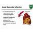 PPT  Biomarkers Of Myocardial Infarction PowerPoint Presentation Free