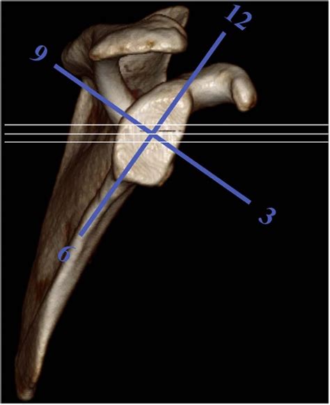 Glenoid Morphology Is Associated With The Development Of Instability