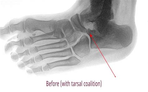 Tarsal Coalitions Pediatric Foot And Ankle