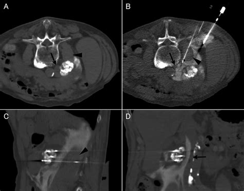 Percutaneous Cryoablation Under Computed Tomography Ct Guidance A