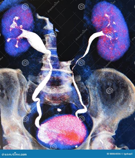 Ct Scan 3d Ct Urography Kidneys Bladder Colorful Royalty Free Stock