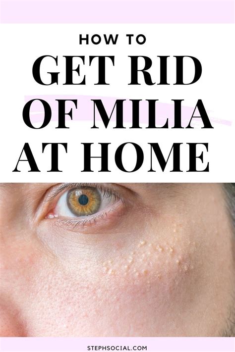 How To Get Rid Of Milia At Home With Tretinoin Steph Social White