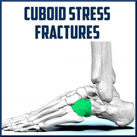 Cuboid Stress Fractures Sports Medicine Review