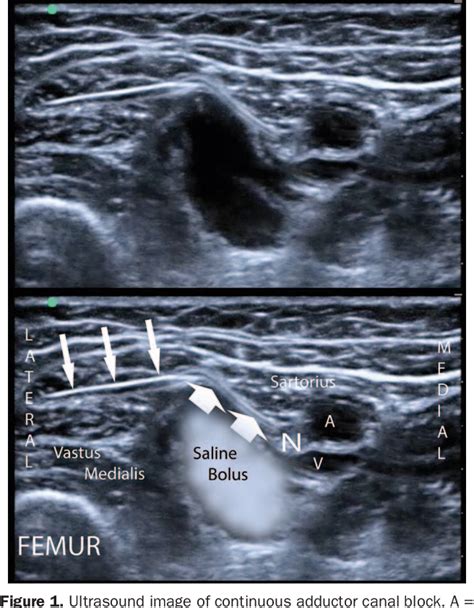 Figure 1 From Continuous Ultrasound Guided Adductor Canal Block For