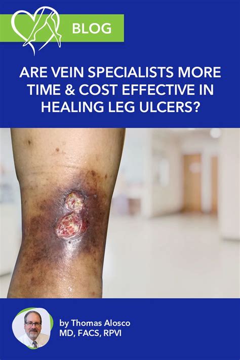 Venous Insufficiency Canterbury Tales Water Retention Varicose Veins