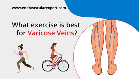What Exercise Is Best For Varicose Veins Endovascular Expert